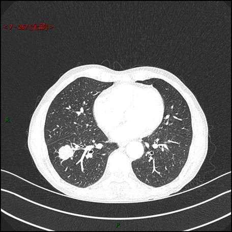 图片[3]-病例1 | 每周呼吸-每周呼吸