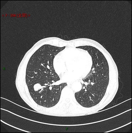 图片[4]-病例1 | 每周呼吸-每周呼吸