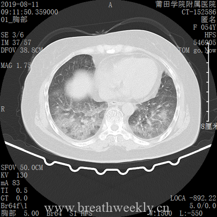 图片[7]-病例库14 | 每周呼吸-每周呼吸