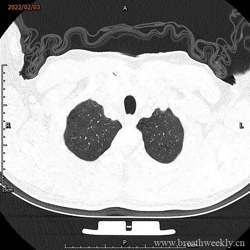 图片[1]-病例16 | 每周呼吸-每周呼吸