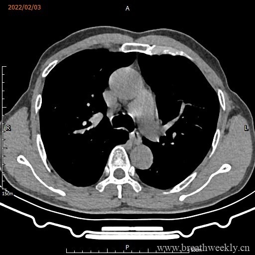 图片[10]-病例16 | 每周呼吸-每周呼吸