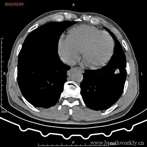 图片[14]-病例16 | 每周呼吸-每周呼吸