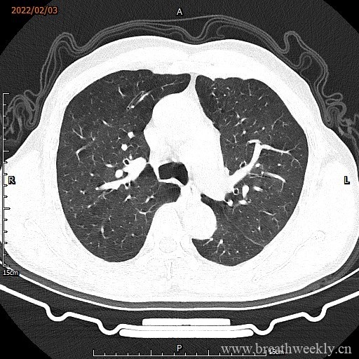 图片[3]-病例16 | 每周呼吸-每周呼吸