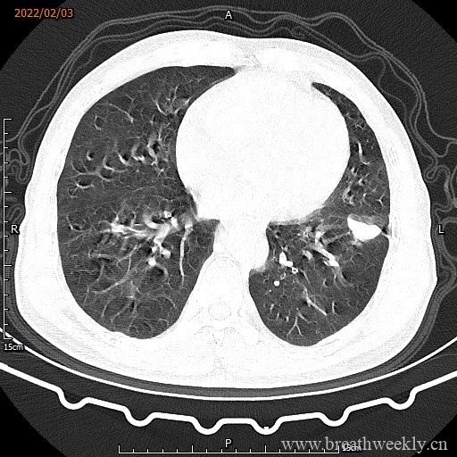 图片[4]-病例16 | 每周呼吸-每周呼吸