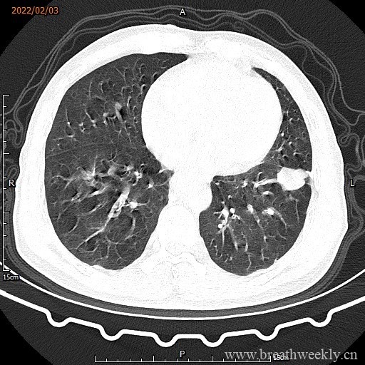 病例16 | 每周呼吸-每周呼吸