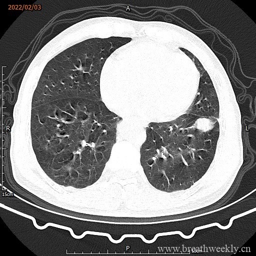 图片[6]-病例16 | 每周呼吸-每周呼吸