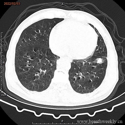 图片[7]-病例16 | 每周呼吸-每周呼吸