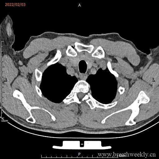 图片[8]-病例16 | 每周呼吸-每周呼吸