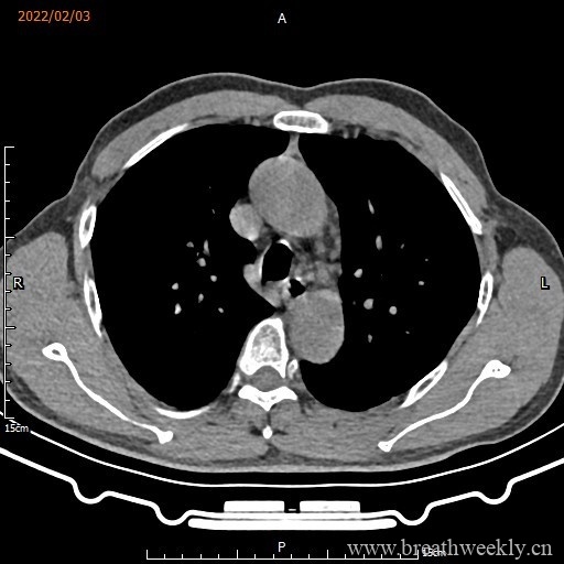 图片[9]-病例16 | 每周呼吸-每周呼吸