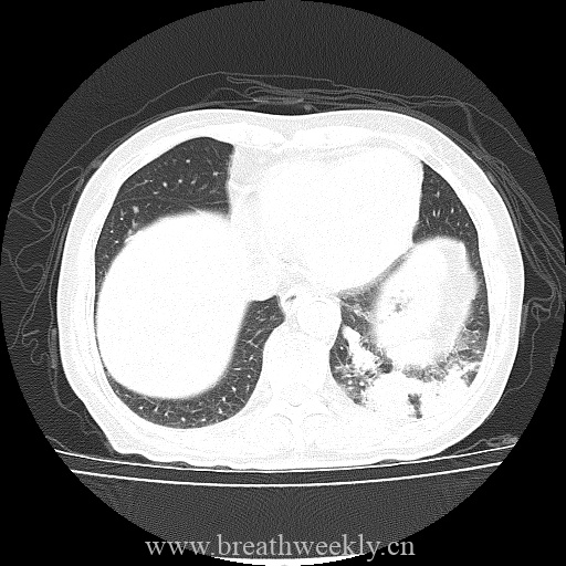 图片[10]-病例库12 | 每周呼吸-每周呼吸