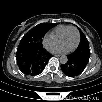 图片[11]-病例17 | 每周呼吸-每周呼吸