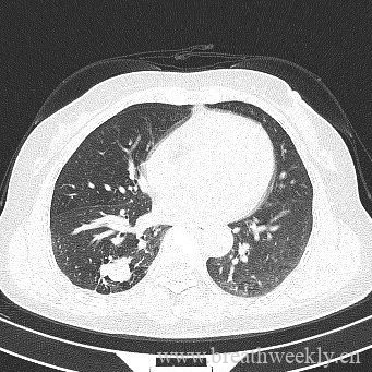 图片[3]-病例17 | 每周呼吸-每周呼吸