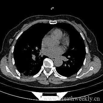 图片[8]-病例17 | 每周呼吸-每周呼吸