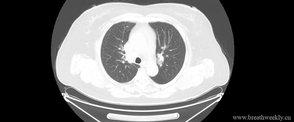 病例18-每周呼吸