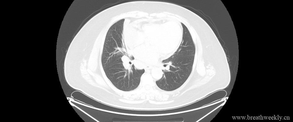 图片[4]-病例18 | 每周呼吸-每周呼吸