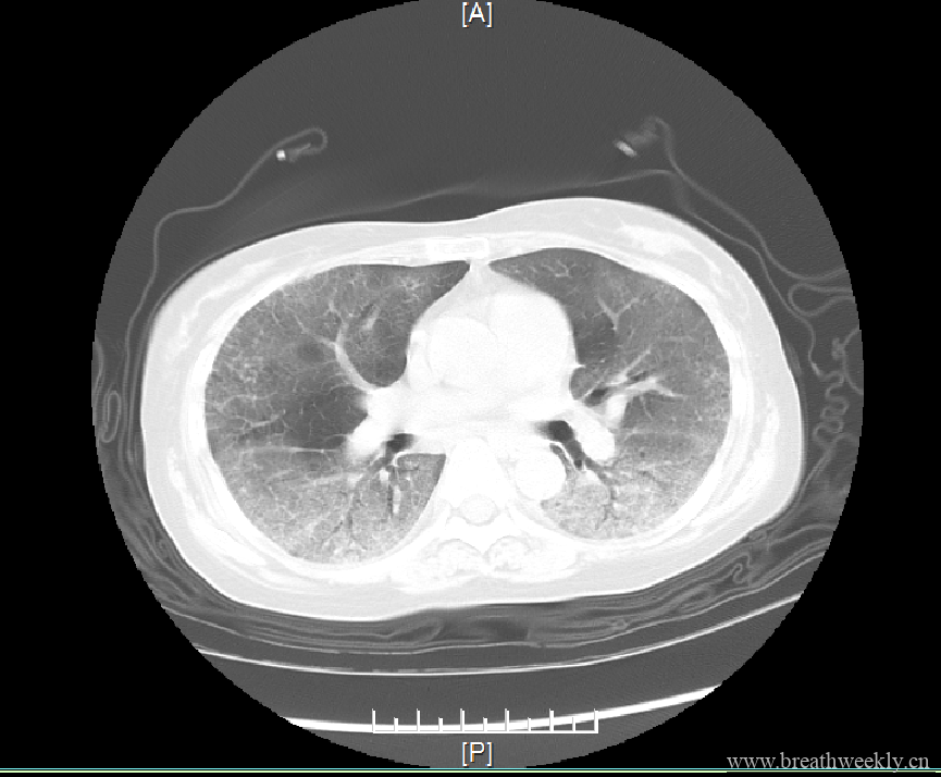 病例19 | 每周呼吸-每周呼吸