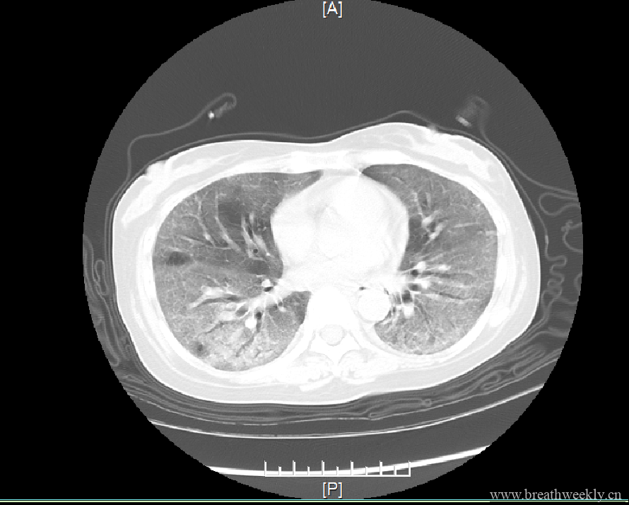 图片[3]-病例19 | 每周呼吸-每周呼吸