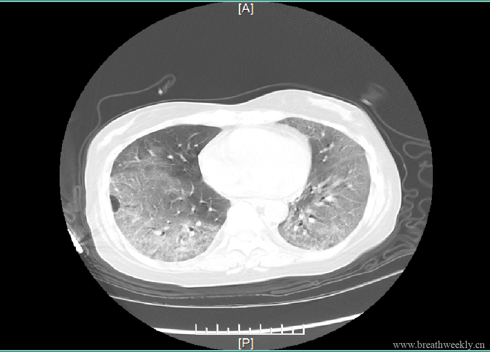 图片[5]-病例19 | 每周呼吸-每周呼吸