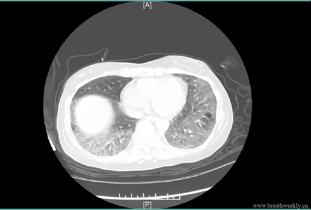 图片[6]-病例19 | 每周呼吸-每周呼吸