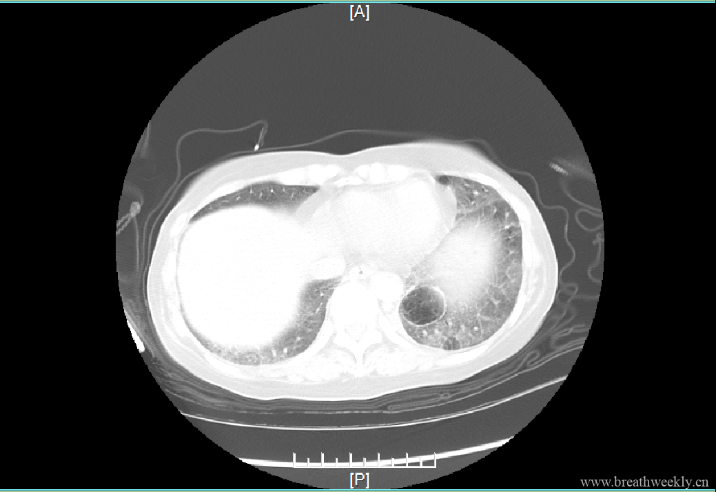 图片[7]-病例19 | 每周呼吸-每周呼吸
