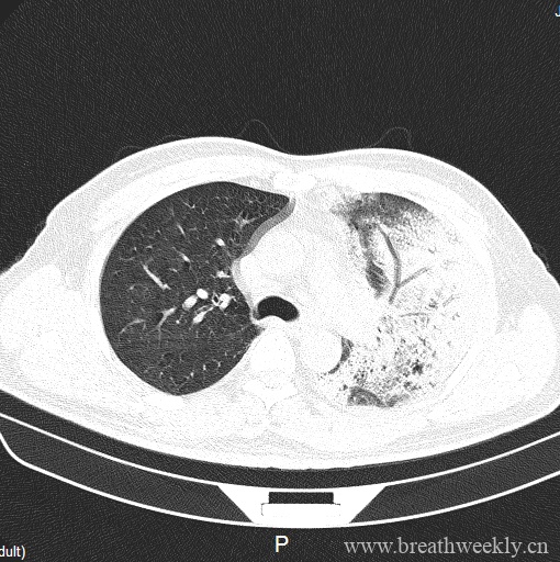 图片[1]-病例20 | 每周呼吸-每周呼吸