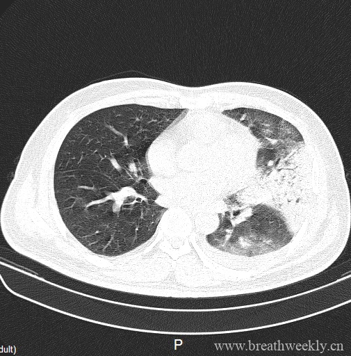 图片[7]-病例20 | 每周呼吸-每周呼吸