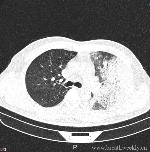 图片[2]-病例20 | 每周呼吸-每周呼吸