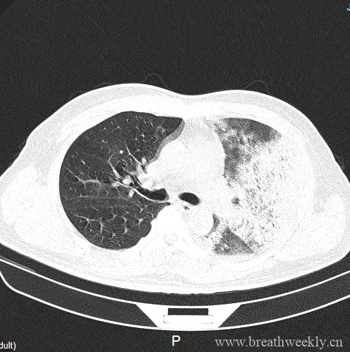 图片[3]-病例20 | 每周呼吸-每周呼吸