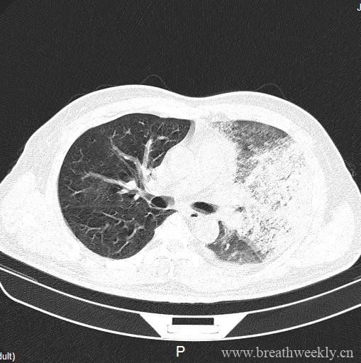 图片[4]-病例20 | 每周呼吸-每周呼吸