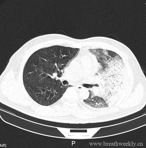 图片[5]-病例20 | 每周呼吸-每周呼吸