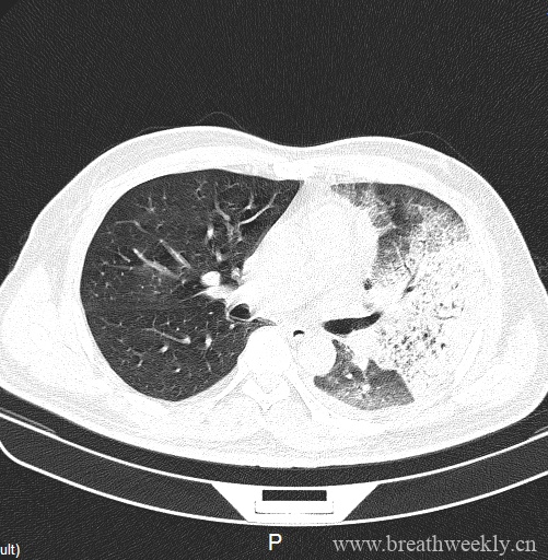 图片[6]-病例20 | 每周呼吸-每周呼吸