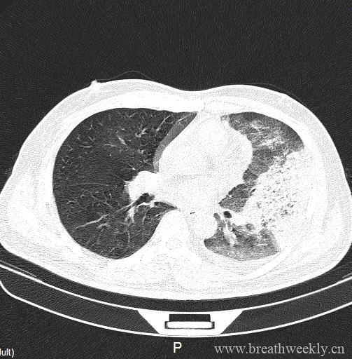 图片[9]-病例20 | 每周呼吸-每周呼吸