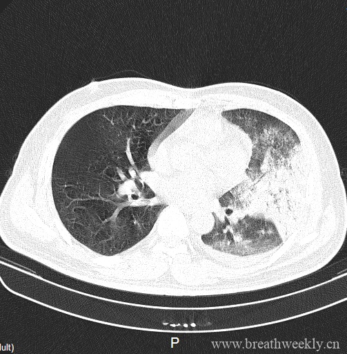 病例20-每周呼吸