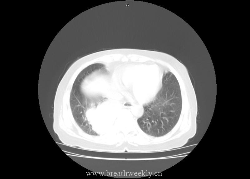 图片[10]-病例21 | 每周呼吸-每周呼吸