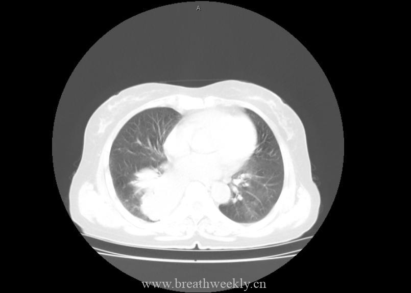 图片[9]-病例21 | 每周呼吸-每周呼吸
