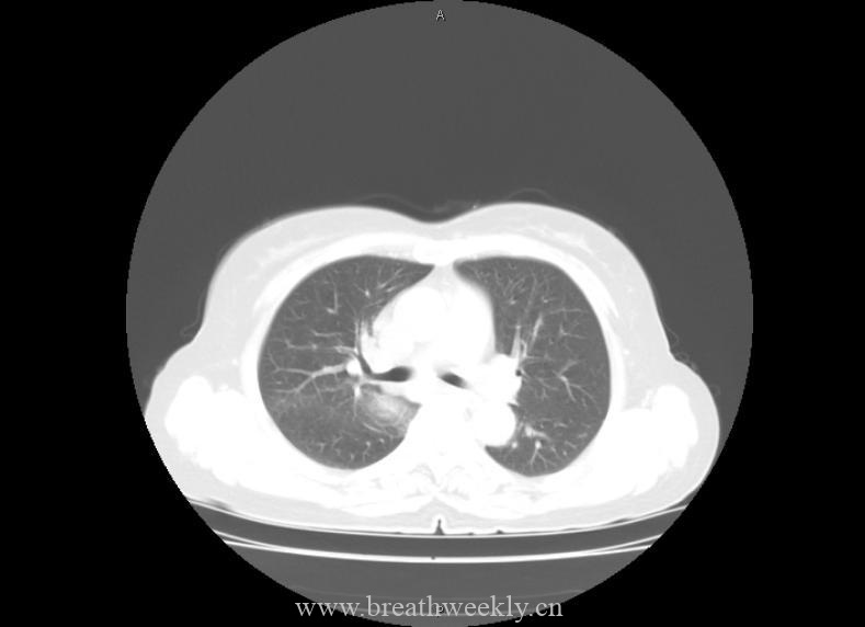 病例21-每周呼吸