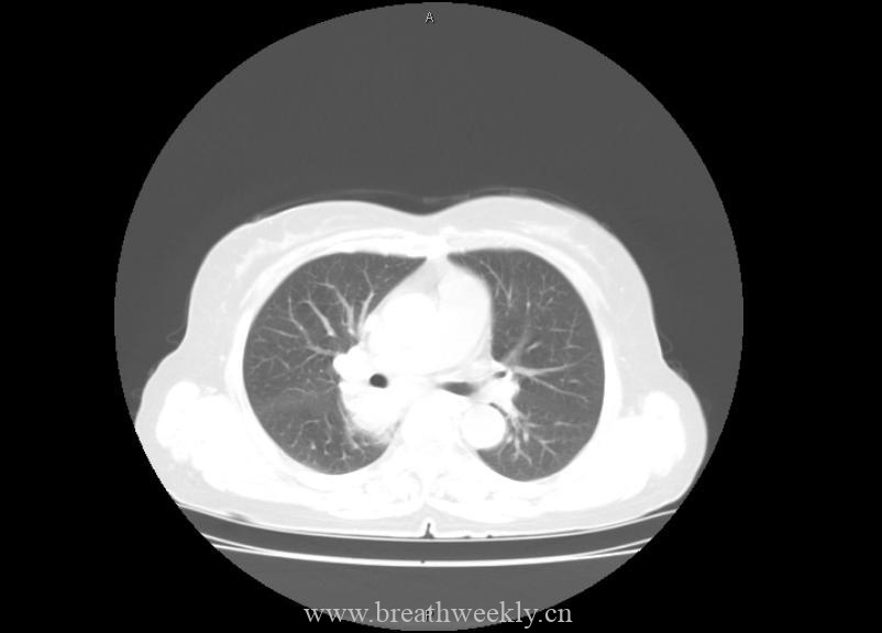 图片[2]-病例21 | 每周呼吸-每周呼吸