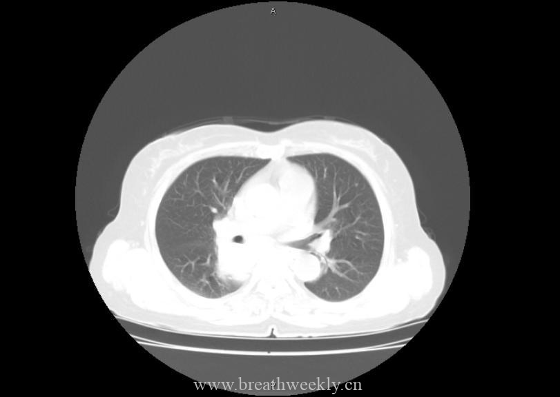 图片[3]-病例21 | 每周呼吸-每周呼吸