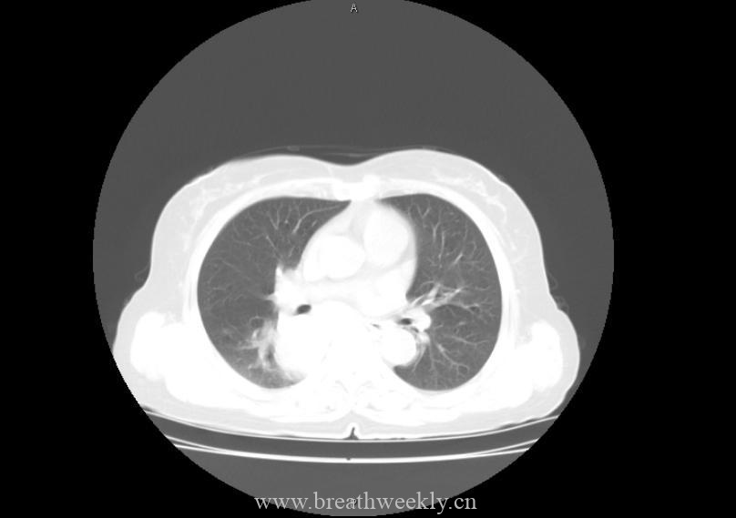 图片[4]-病例21 | 每周呼吸-每周呼吸