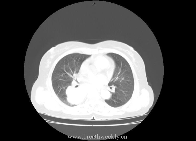 图片[6]-病例21 | 每周呼吸-每周呼吸