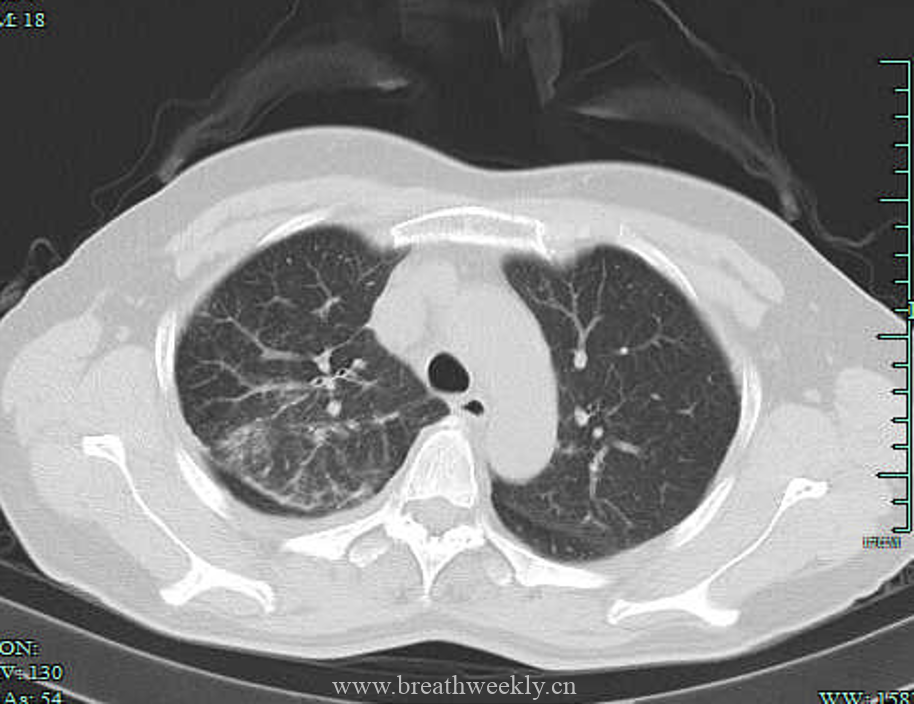 图片[1]-病例23 | 每周呼吸-每周呼吸