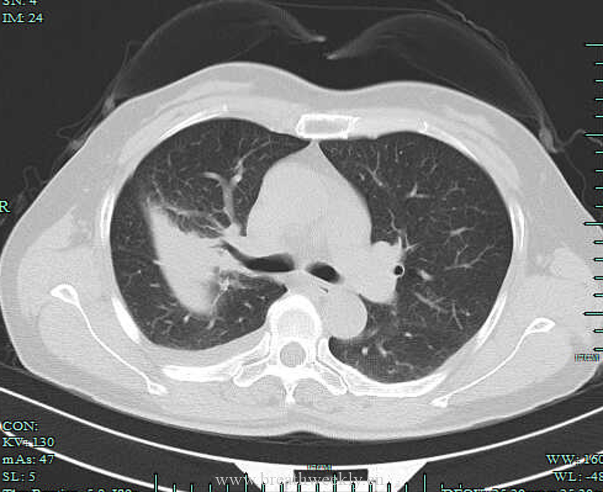 图片[7]-病例23 | 每周呼吸-每周呼吸