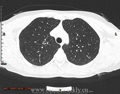 图片[1]-病例29 | 每周呼吸-每周呼吸