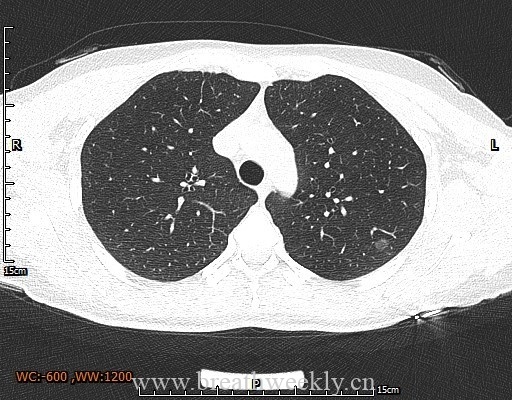 图片[3]-病例29 | 每周呼吸-每周呼吸