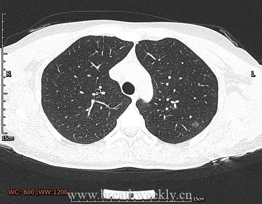 图片[4]-病例29 | 每周呼吸-每周呼吸