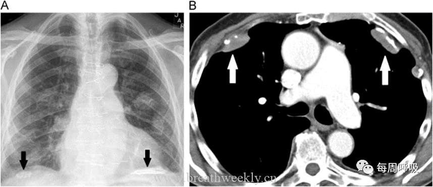 图片[15]-肺部钙化性疾病有哪些? | 每周呼吸-每周呼吸