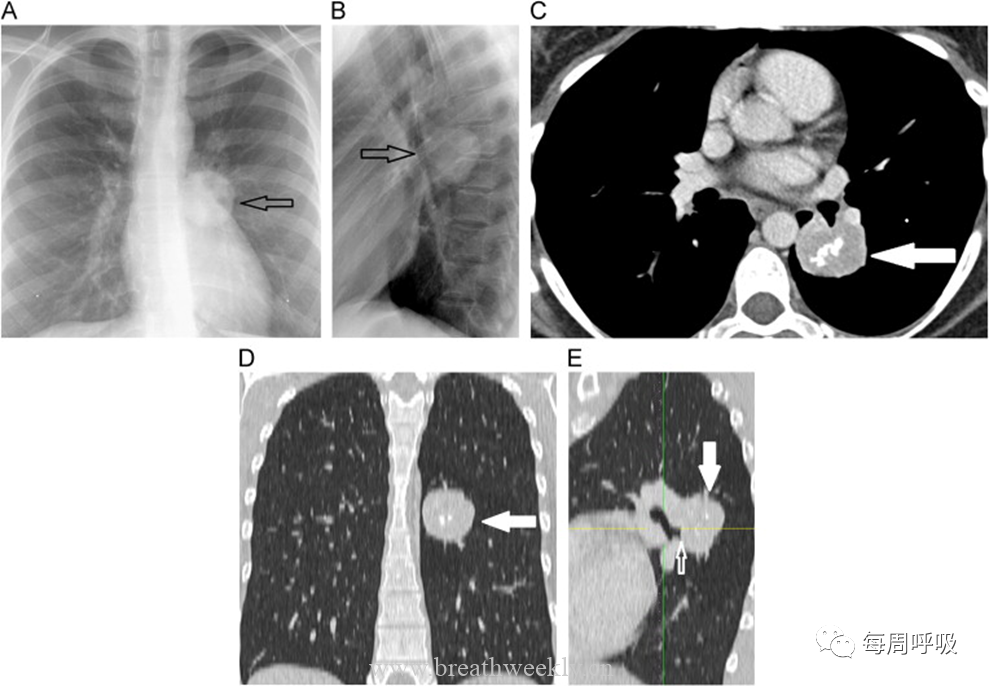 图片[3]-肺部钙化性疾病有哪些? | 每周呼吸-每周呼吸