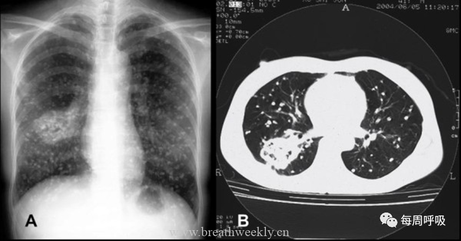 图片[17]-肺部钙化性疾病有哪些? | 每周呼吸-每周呼吸
