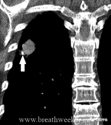 图片[4]-肺部钙化性疾病有哪些? | 每周呼吸-每周呼吸