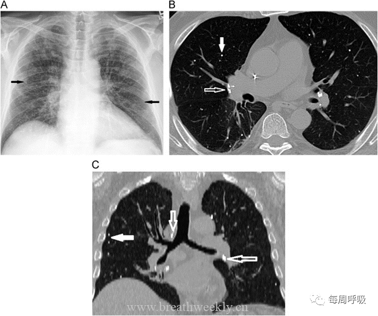 图片[11]-肺部钙化性疾病有哪些? | 每周呼吸-每周呼吸
